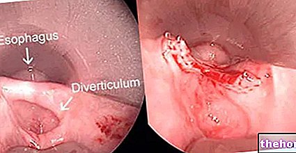 Esophageal diverticula: Diagnosis and Therapy - health-of the esophagus