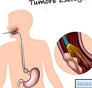 Tumor esofagus - kesihatan-esofagus