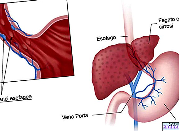 Esophageal varices - health-of the esophagus