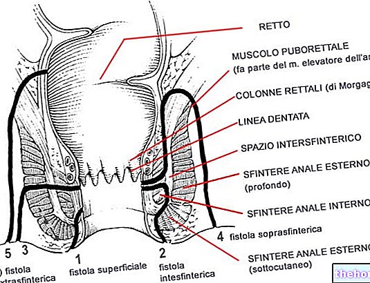 Fistules anales - santé intestinale