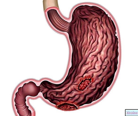Gastric ulcer - stomach-health