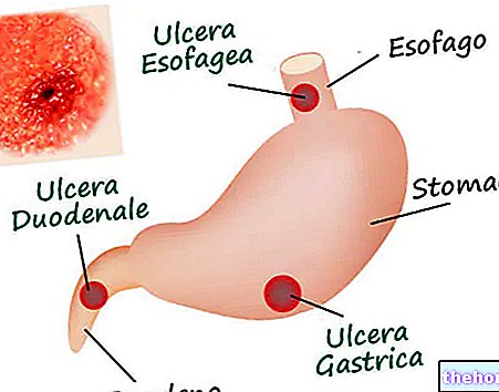 Peptic ulcer - stomach-health