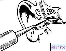 Почистване на ушите - здраве на ушите