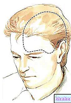 Sakit kepala kluster - kesihatan