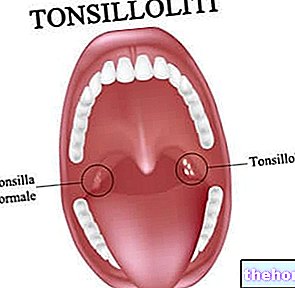 Tonsillolites - kameny mandlí - zdraví