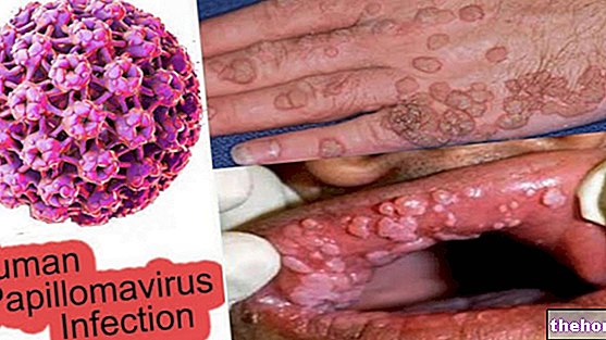 HPV -oireet - ihmisen papilloomavirus - oireita