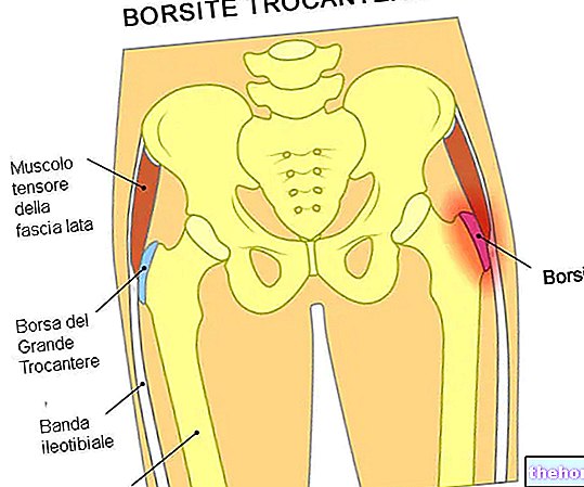 Bursitis trokanterika - traumatologi