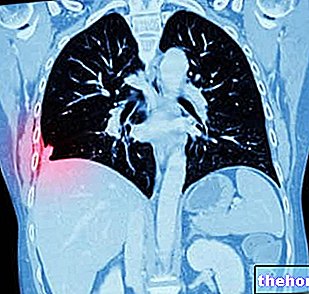 Plaučių adenokarcinoma