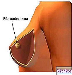 Fibroadenoma payudara - tumor
